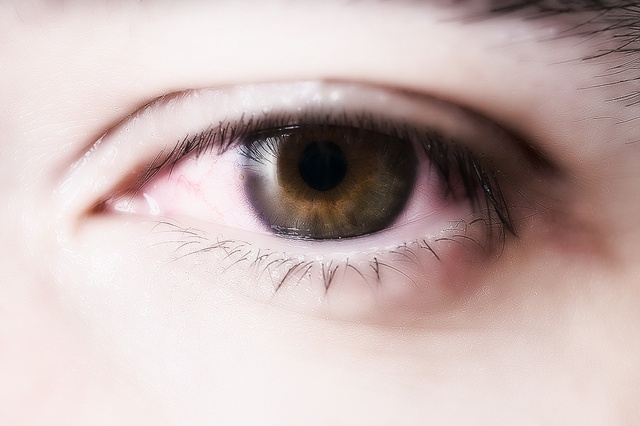 Головная боль красные глаза причины и лечение