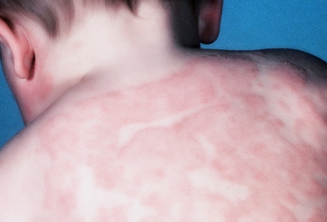 Лечение атопического дерматита у грудных детей гомеопатией